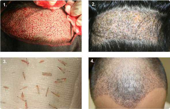 FUE Hårtransplantation
