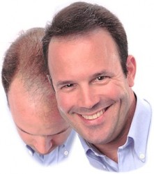 Hårtransplantation ved hartab Hårtransplantation ved hartab