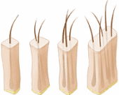Hårtransplantat