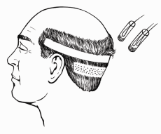 Forskelle mellem FUE og STRIP hårtransplantation