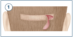 Metoder for hårtransplantation – STRIP Metoder for hårtransplantation – STRIP
