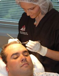 Hårtransplantation med FUE (FUT)-metoden