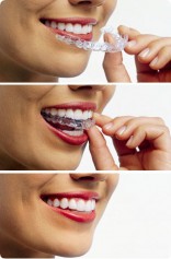 Invisalign tandbøjler