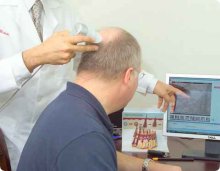 Sådan bliver en hårtransplantation udført