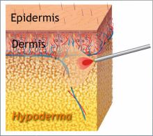 Laserfedtsugning (Smart Lipo)