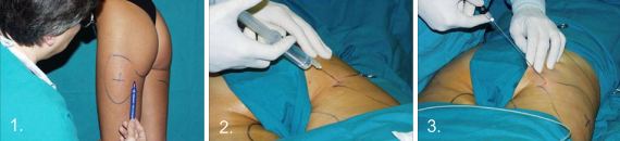 Operationsforløb ved laserfedtsugning