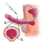Penisfortykkelse med Macrolane (fillers)