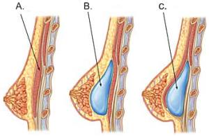 Placering af implantaterne - over eller under musklen Placering af implantaterne - over eller under musklen