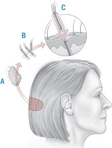hårtransplantation – FUE/FUT eller STRIP